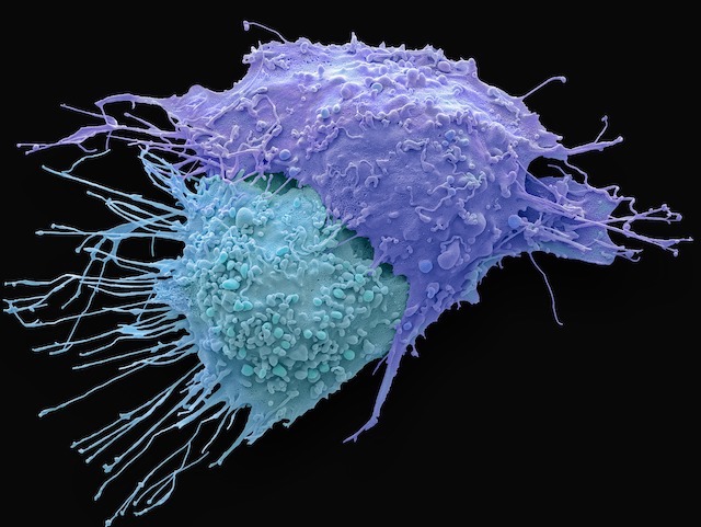 Ovarian cancer cells micrograph